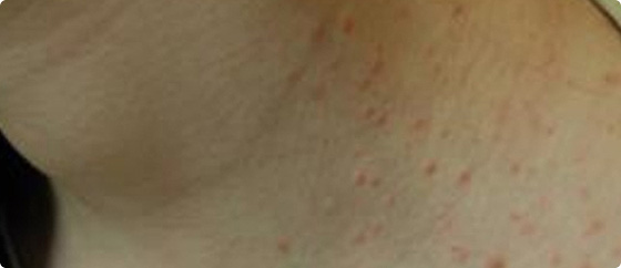 붉거나 피부색에 가까운 돌기 참고 사진