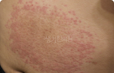 몸통에 여러 개 나타나는 발진 참고 사진
