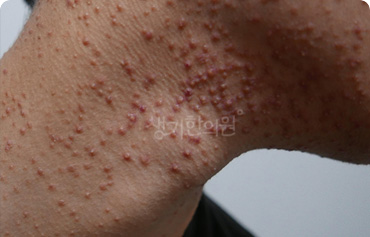 턱·목 주변의 반복 병변 참고 사진