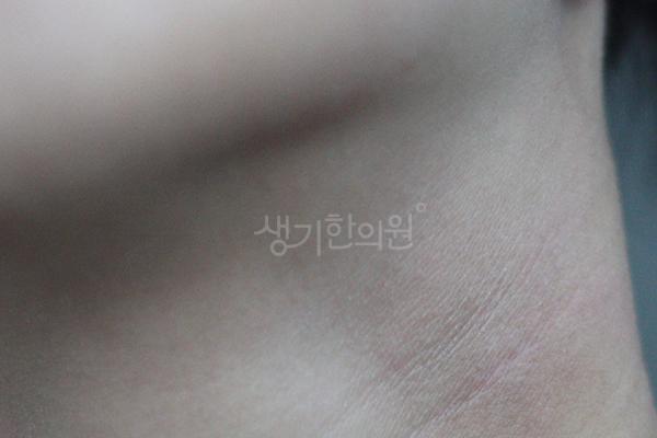 아토피 치료 후 사진 · 치료기간 8개월 · 생기한의원 청주점