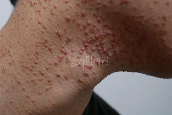 모낭염 치료 전 사진 · 생기한의원 청주점