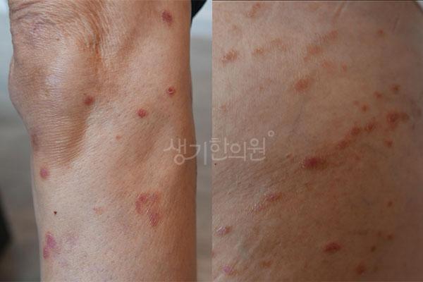 건선 치료 전 사진 · 생기한의원 청주점
