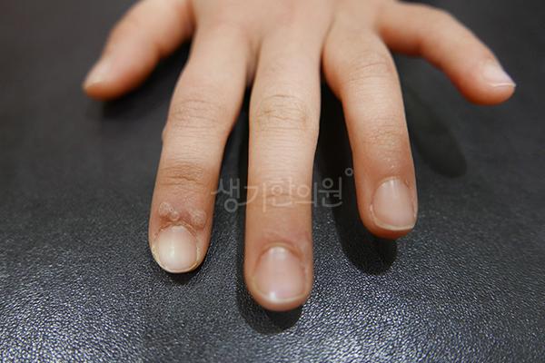 사마귀 치료 전 사진 · 생기한의원 청주점