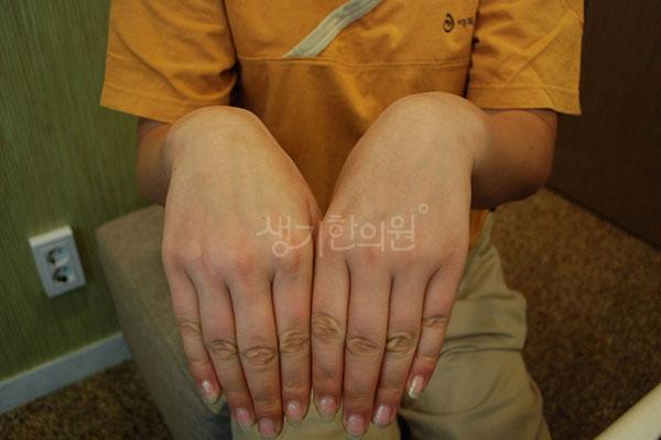 건선 치료 후 사진 · 치료기간 4개월 · 생기한의원 청주점